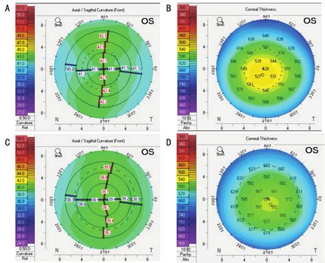 central corneal thickness measurement|central corneal thickness chart.